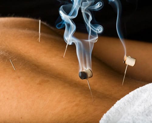 Accupuncture Treatments