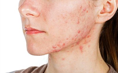 Skin Disorders – Treat with NAET