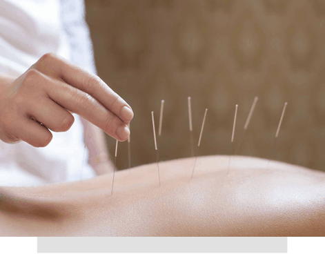 Acupuncture