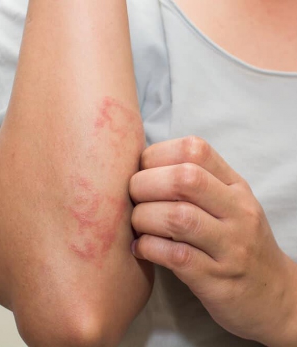 11-Silent-Signs-of-Mono-9 SKIN DISORDERS