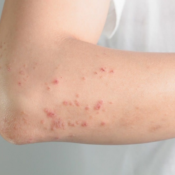 How-can-we-treat-skin-allergies-caused-by-fabric How-can-we-treat-skin-allergies-caused-by-fabric